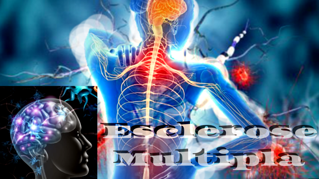 Esclerose Multipla