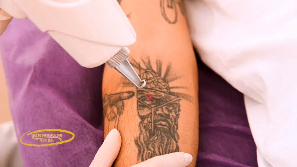 remoção de tatuagens